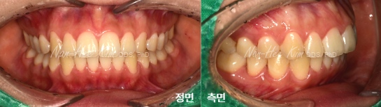 치료 후 · 앞니가 점점 틀어져요, 설측교정 대신 투명교정을 선택한 성인교정 사례