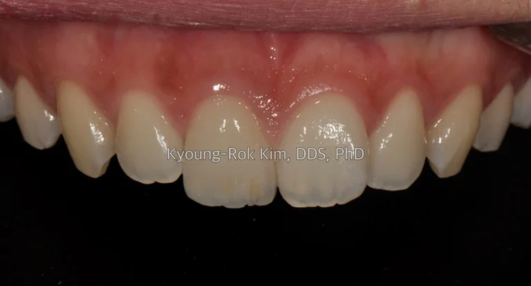 치료 후 · 전치부 재수복 치료 증례