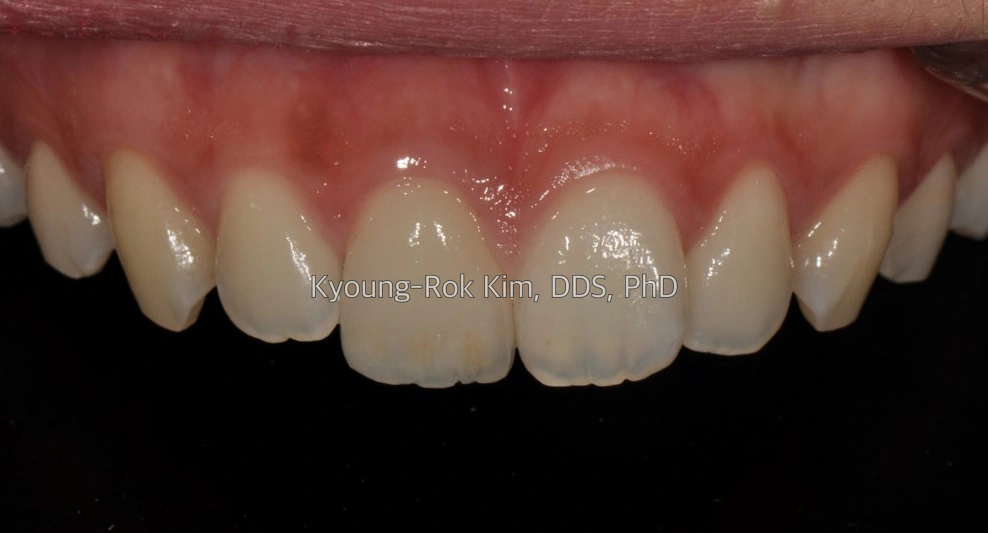 치료 후 · 전치부 재수복 치료 증례