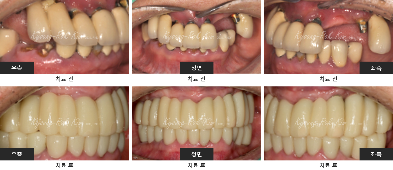동일 환자의 치료 전후 우측·정면·좌측 구강 사진