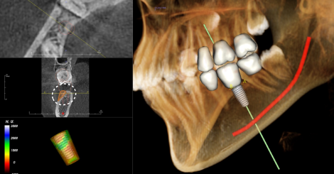 임플란트 부위의 협측골을 확인한 CT | Implant Bone Graft CT | 더채움치과 더채움치과 임플란트 부위의 협측골을 확인한 CT, implant bone graft ct