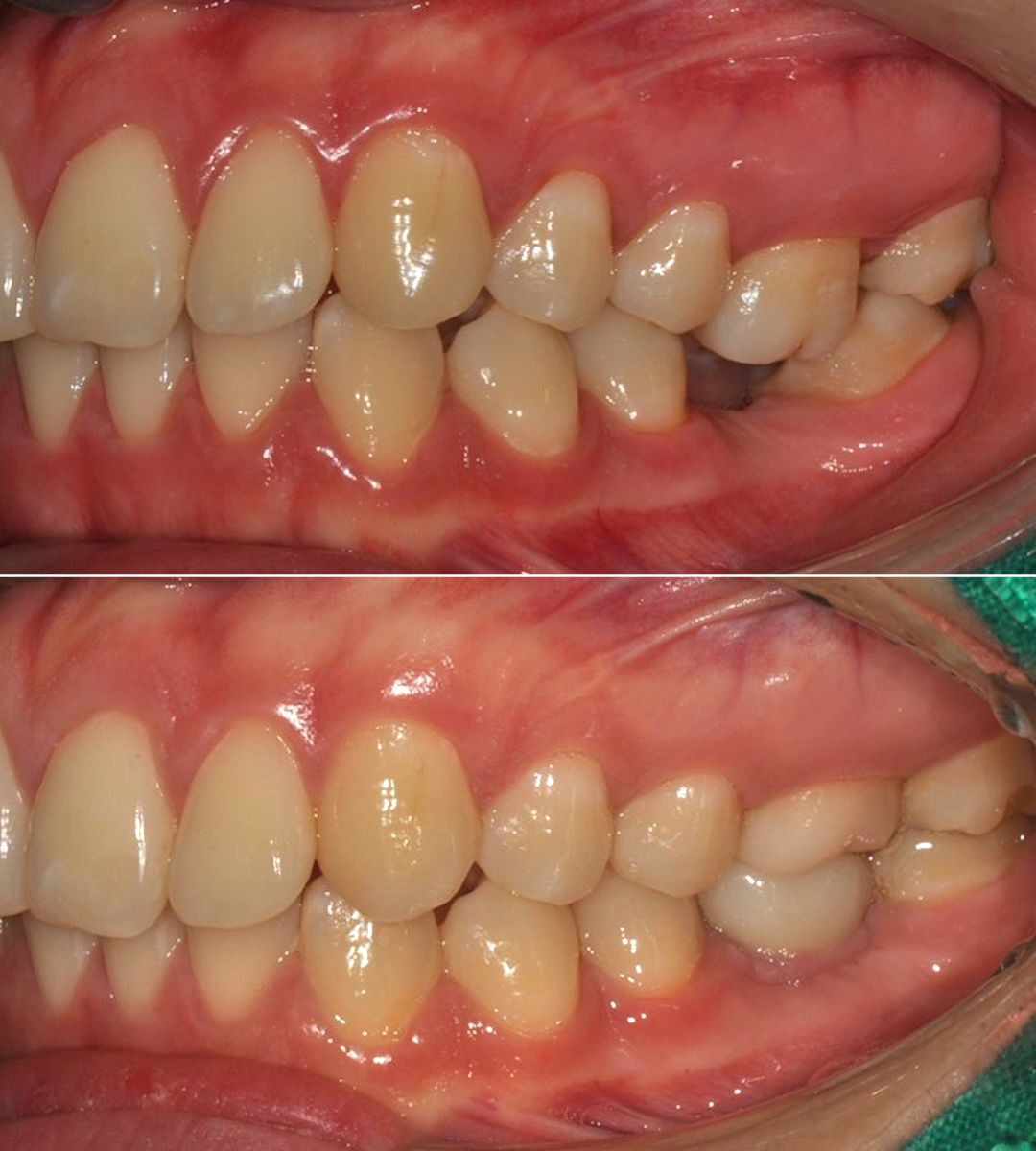 부분교정 후 임플란트 치료 전후 구강사진 | Partial Orthodontics Implant Before After | 더채움치과 더채움치과 부분교정 후 임플란트 치료 전후 구강사진, partial orthodontics implant before after