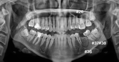 부분교정 전 파노라마 | Panoramic X-ray Before | 더채움치과 더채움치과 부분교정 전 파노라마, panoramic x-ray before