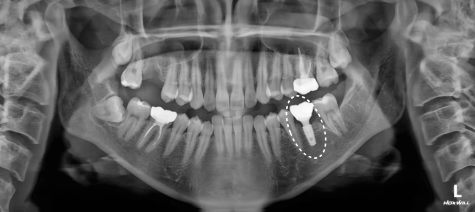 임플란트와 크라운 치료 후 경과 파노라마 | Implant Crown Follow-up X-ray | 더채움치과 더채움치과 임플란트와 크라운 치료 후 경과 파노라마, implant crown follow-up x-ray