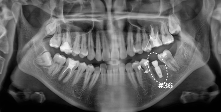 임플란트 식립 후 파노라마 | Implant Placement X-ray | 더채움치과 더채움치과 임플란트 식립 후 파노라마, implant placement x-ray