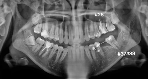 부분교정 후 임플란트 식립 전 파노라마 | Pre-implant Panoramic X-ray | 더채움치과 더채움치과 부분교정 후 임플란트 식립 전 파노라마, pre-implant panoramic x-ray