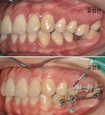 부분교정 전과 치료 중 구강사진 | Partial Orthodontics Progress | 더채움치과 더채움치과 부분교정 전과 치료 중 구강사진, partial orthodontics progress