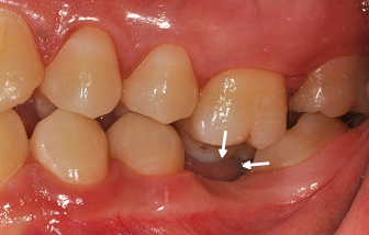 기울어진 어금니와 정출된 위 어금니 | Tilted Molar Before | 더채움치과 더채움치과 기울어진 어금니와 정출된 위 어금니, tilted molar before