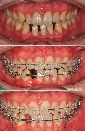 매릴랜드 브릿지를 위한 교정 진행 과정 | Orthodontic Space Preparation | 더채움치과 더채움치과 매릴랜드 브릿지를 위한 교정 진행 과정, orthodontic space preparation
