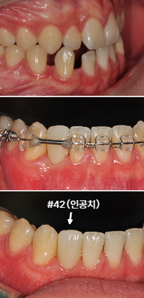 매릴랜드 브릿지 부착 전후와 교정장치 제거 후 | Maryland Bridge Restoration | 더채움치과 더채움치과 매릴랜드 브릿지 부착 전후와 교정장치 제거 후, maryland bridge restoration