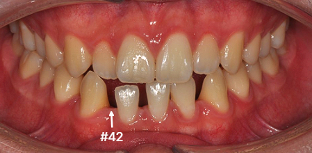 영구치 결손과 앞니 반대교합 치료 전 | Missing Lower Incisor Before | 더채움치과 더채움치과 영구치 결손과 앞니 반대교합 치료 전, missing lower incisor before
